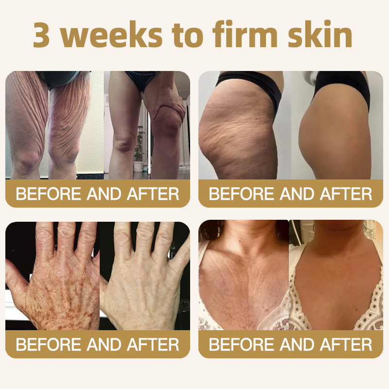 🔥 80%OFF — FINAL 3 HOURS🔥Turonu® Botox Bee Venom Microneedle Firming Patch (Bat Wings,Stretch Marks,Wrinkles & Cellulite — Just 10 Minutes a Day,Visible Results in 7 Days.)