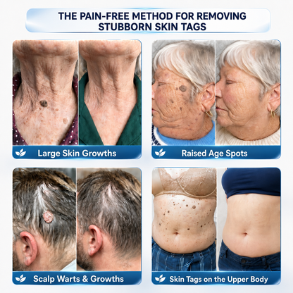 🇺🇸𝗖𝘂𝗿𝗲𝗩𝗶𝘃𝗼® 𝟕-𝐃𝐚𝐲 𝐒𝐤𝐢𝐧 𝐓𝐚𝐠 & 𝐒𝐩𝐨𝐭 𝐑𝐞𝐦𝐨𝐯𝐚𝐥 𝐂𝐫𝐞𝐚𝐦 (𝐏𝐚𝐢𝐧𝐥𝐞𝐬𝐬 𝐅𝐨𝐫𝐦𝐮𝐥𝐚 – 𝐍𝐨 𝐒𝐜𝐚𝐫𝐬)
